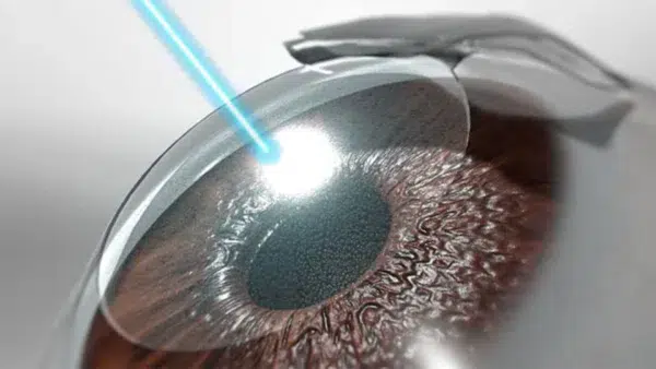 lasik-eye-surgery